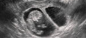 Vanishing twin syndrome ultrasound