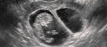 Vanishing twin syndrome ultrasound